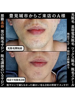 ディースタイル 北谷店(Dstyle)/北谷メンズ脱毛ヒゲBefore after