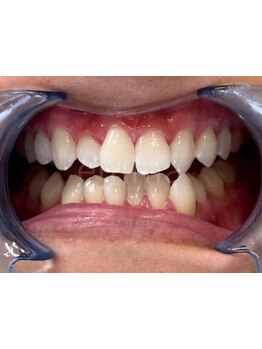 美白ケアをしたい