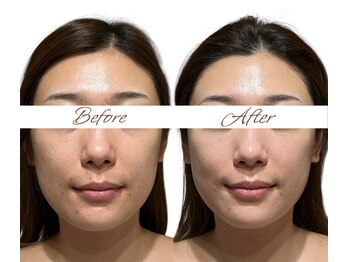 マヌレニ(manuleni)/たるみの簡単な判断基準は