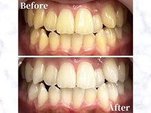 LBSホワイトニング 銀座店/セルフホワイトニングの症例写真