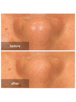 アットウィル 志木店(at will)/毛穴洗浄BeforeAfter