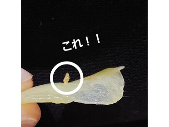 リリハナ(Ririhana)/大きめな角栓２