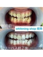 ホワイトニングショップ 岐阜駅前/#岐阜ホワイトニング#岐阜エステ