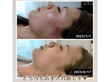 シュガー 津市(Sugar)の雰囲気（【結果重視】月1回のハーブピーリングでここまで変わる！！）