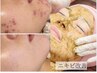 【繰り返しニキビケア/凸凹肌改善】素肌美人ハーブピーリング24,000→ 