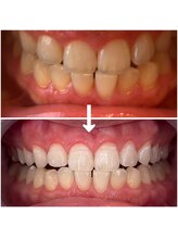 エクシアホワイトニング 代々木店/ビフォーアフターホワイトニング