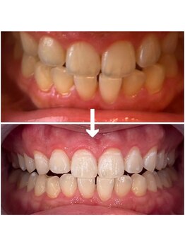 エクシアホワイトニング 代々木店/ビフォーアフターホワイトニング