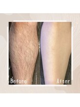 ルミナ(Lumina)/メンズ脱毛