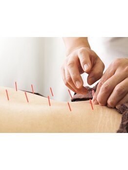 鍼灸施術を受けたい