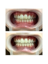 ワイズサロン(Y's salon)/ホワイトニング１回の症例です！