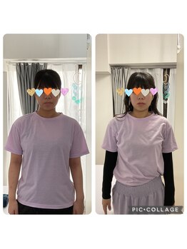 オスベル(OSBELLE)/頭蓋骨小顔矯正　20代女性　5回