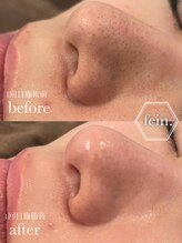 フェイン 青山店(fein.)&nbsp;肌質改善 ピーリング