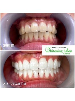 ホワイトニングサロン 名古屋駅店/【ホワイトニング施術例】