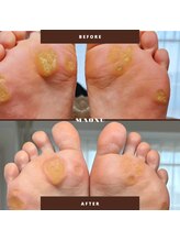 マオヌー(MAONU)/韓国式足裏角質ケア　症例写真