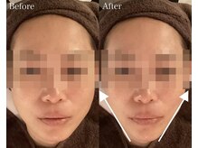 ベル 後楽園 春日(Belle)/小顔/リフトアップ/二重顎