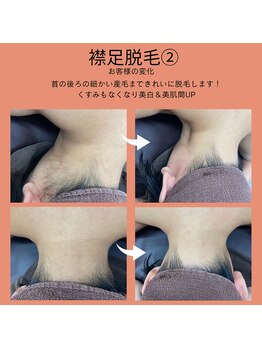 ベルミ―ランド いなげや大和相模大塚/襟足脱毛２