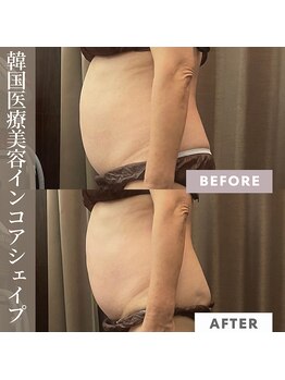 リラクゼーションサロン ラキ(laki)の写真/【エステ版オンダリフト】結果出しに自信◎
お腹・太もも引き締め、背中、スッキリ、肩こり等の痛み軽減も