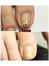 ナビネイル(Nabi nail)/BS　巻き爪緩和