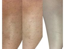 キミドリ(KIMIDORI)/大人気脱毛