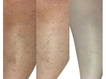 キミドリ(KIMIDORI)/大人気脱毛