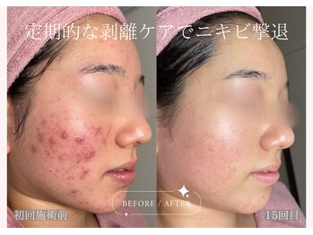 ティセラ(TISERA.)