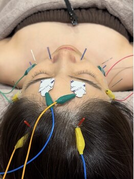 ミプラス鍼灸スタジオ/美容鍼