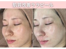 BUB 立川/渡韓せずララピールができます