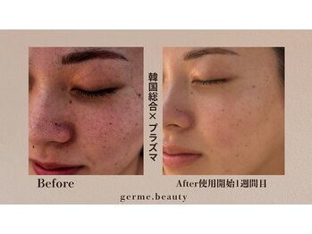 ジェルム(germe.)の写真/【高圧ジェット×小顔】エアーの力で筋肉をほぐしリフトアップ！むくみ解消でキュッと引き締まった印象に