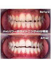 ライトビューティー 関内店(LIGHT BEAUTY)/【ハイパワーホワイトニング】
