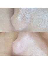 フォルス 天王寺(fors)/小鼻もキレイにフェイスワックス