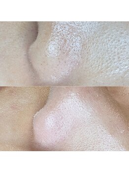 フォルス 天王寺(fors)/小鼻もキレイにフェイスワックス