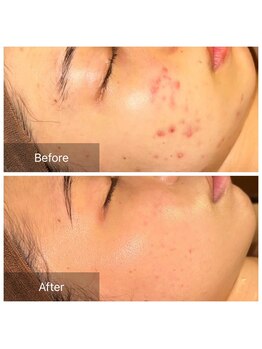 ディーキャットリー(D Catrry)/ハーブピーリング