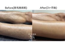 ２～3週間おきに通えて、キレイを維持したまま脱毛可能♪