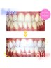 【口コミ特典】セルフホワイトニング <9分×2セット>1回　¥3,980→¥500