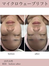 ココ(COCO)/マイクロウェーブリフト/小顔