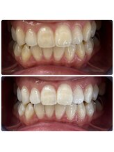 グリッター ショウナン(glitter. SHONAN)/藤沢ホワイトニングbefore/after