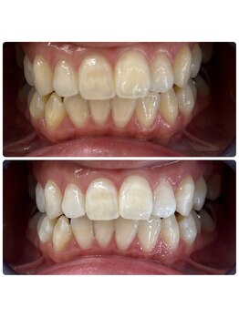 グリッター ショウナン(glitter. SHONAN)/藤沢ホワイトニングbefore/after