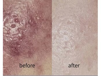 リズ(rE:S)/広島初!ブルーピール 男性