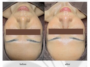 アン ビューティー(ann beauty)/施術2回【症例写真】50代