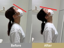 せなかのはね 難波心斎橋店/30代 女性 首こり 頭痛