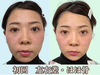 ナチュラルパーフェクトフェイス 新宿/初回ビフォーアフター／新宿小顔