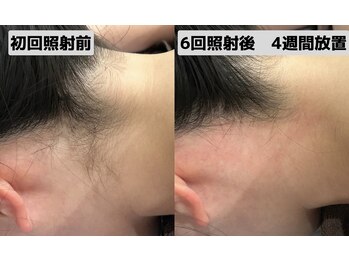 ロワ(Roi)/【全身脱毛×ボディーケア保湿】