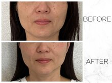 コノハナ(conohana)/6回目であごがキュッと。