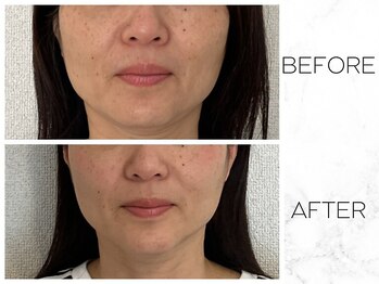 コノハナ(conohana)/6回目であごがキュッと。