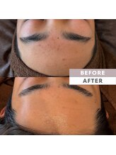 サロンドポノ(Salon de Pono)/ニキビケアプログラム