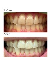 ノーブル 上土店(Noble)/ホワイトニングBeforeAfter