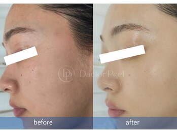 ハーシークレット(Her secret)/ダクトピール+毛穴洗浄