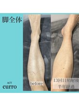 アクト クロ(ACT curro)/【脚全体】脱毛施術例
