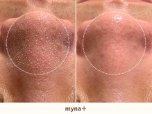 マイナプラ 表参道(myna+)/3STEPハイドラ毛穴洗浄