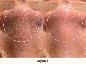 マイナプラ 表参道(myna+)/3STEPハイドラ毛穴洗浄